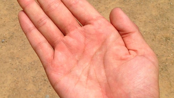 Por qué me salen ampollas en las manos