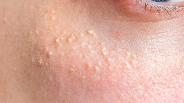Cómo eliminar los granos de grasa de la cara: quistes de milium