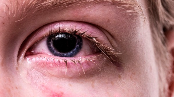 Qué son esos puntos rojos en la piel: petequias