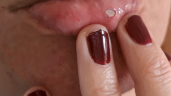 Qué hacer si tienes aftas bucales. Remedios para las llagas en la boca