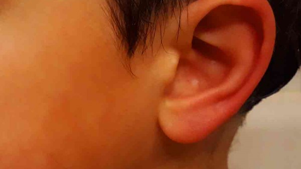 Por qué tengo las orejas rojas y calientes