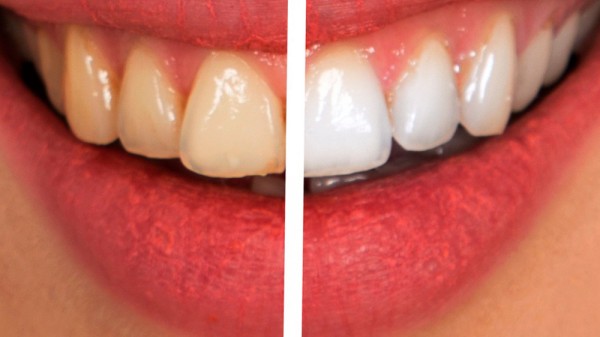 Por qué tengo los dientes amarillos y cómo blanquearlos