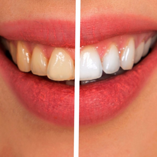 Por qué tengo los dientes amarillos y cómo blanquearlos