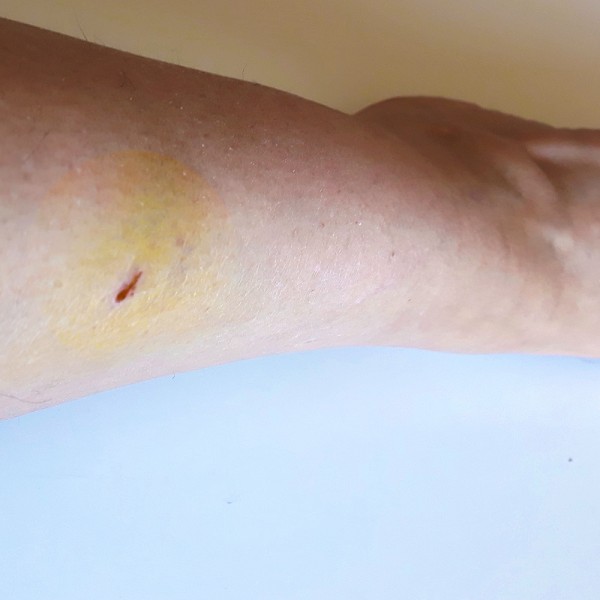 Golpe en la espinilla: por qué duele tanto la tibia y cómo aliviar la molestia