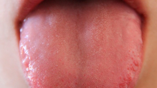 Por qué tengo la lengua agrietada: causas y tratamiento para las fisuras de la lengua