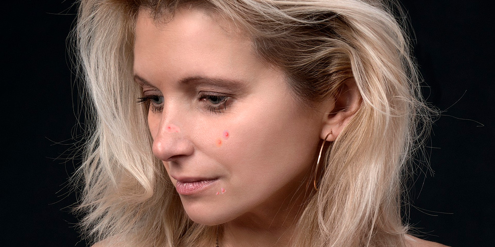 acne en la menopausia