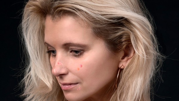 Cómo acabar con el acné en la menopausia