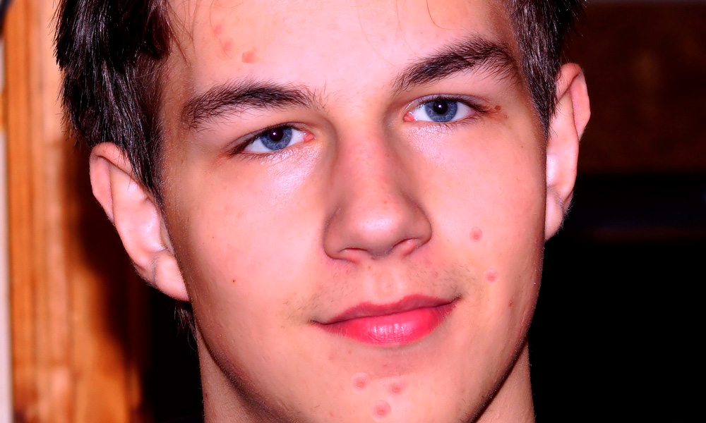 acné en la adolescencia