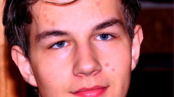 Cómo combatir el acné en la adolescencia