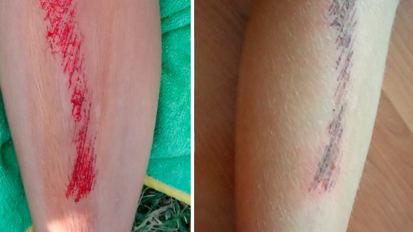Cómo curar un arañazo o raspadura en la piel