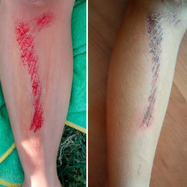 Cómo curar un arañazo o raspadura en la piel