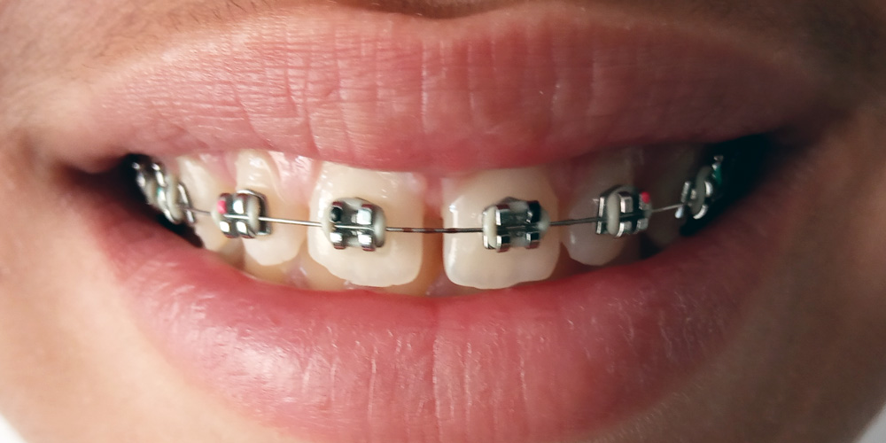 primeros días con ortodoncia