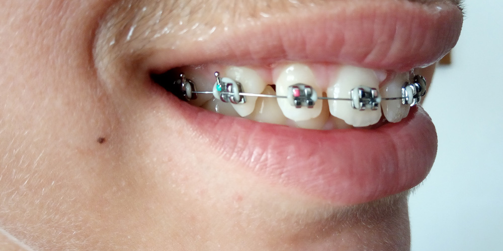 primeros días con los brackets