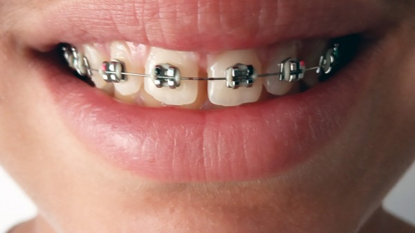 Cómo sobrevivir a los primeros días de ortodoncia