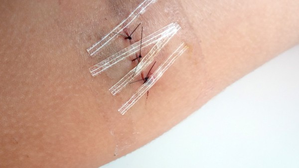 Cómo curar una herida con puntos de sutura o grapas