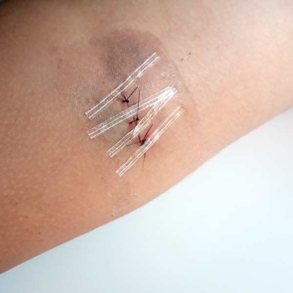 Cómo curar una herida con puntos de sutura o grapas