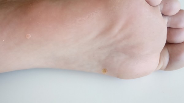 Papiloma en los pies: ¿qué causa esta infección y cómo tratarla?