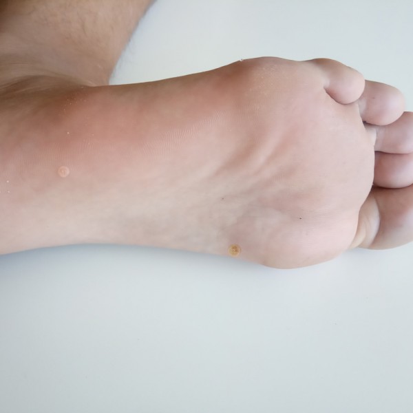 Papiloma en los pies: ¿qué causa esta infección y cómo tratarla?