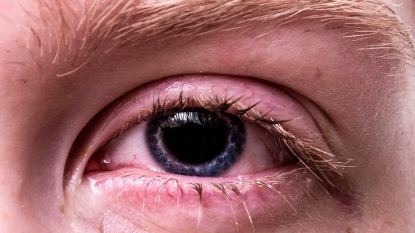 Cómo eliminar un cuerpo extraño del ojo