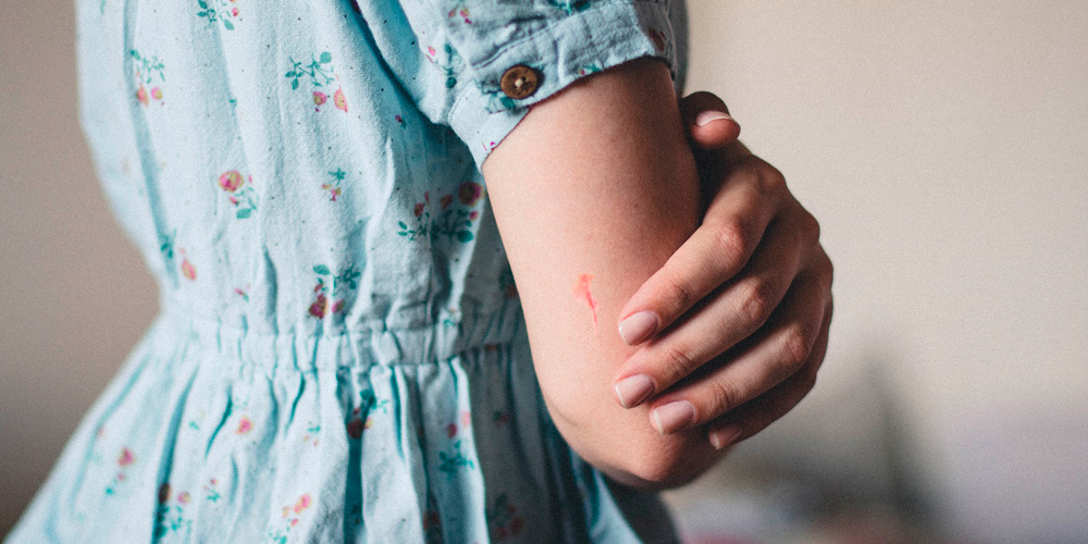 trucos para reducir la apariencia de una cicatriz