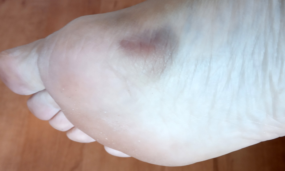 lesión en la planta del pie