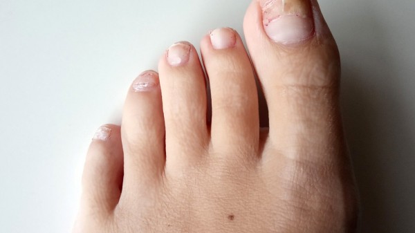 Uña del pie rota o desprendida: ¿qué hacer?