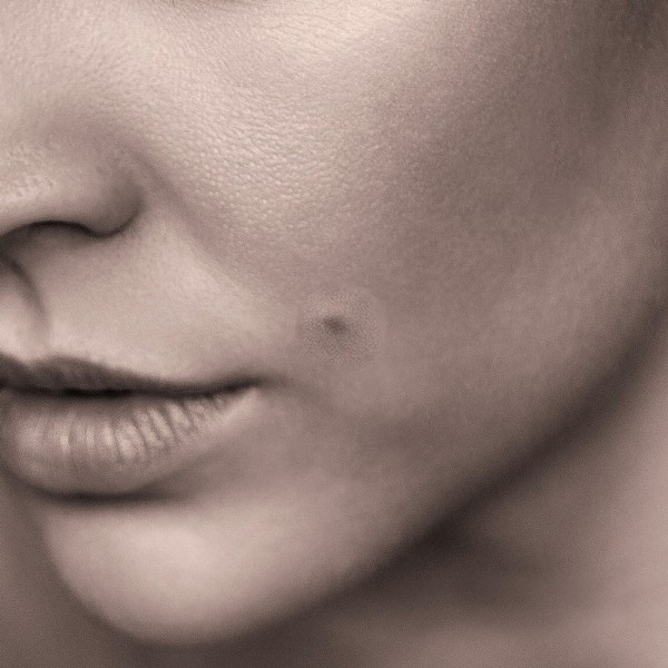 Qué hacer si me arranco un lunar accidentalmente