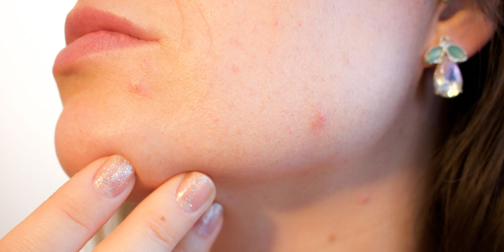 tengo granos en la vida adulta