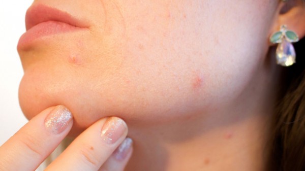 Por qué me salen granos. La explicación al acné en la vida adulta