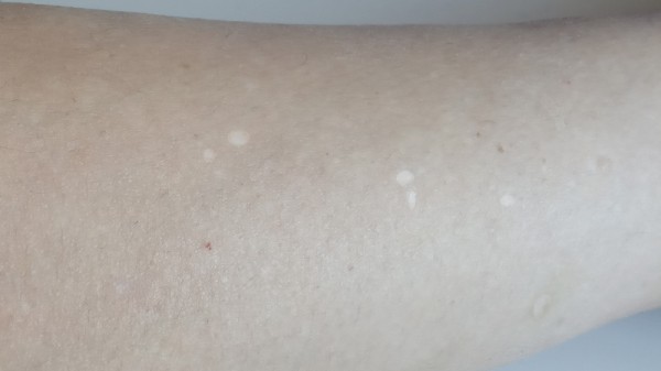 Manchas blanca en la piel: ¿qué son y cómo tratarlas?