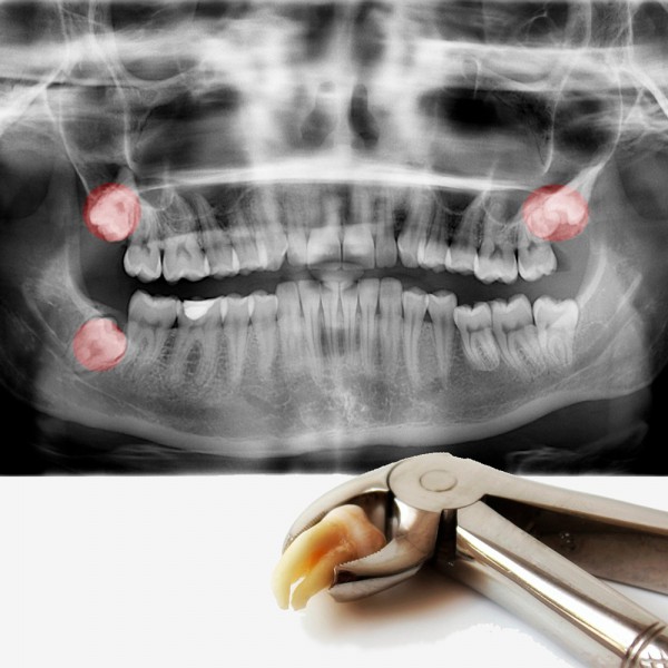 ¿Es necesario quitar las muelas del juicio?