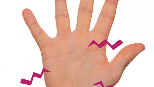 Por qué me pican las palmas de las manos