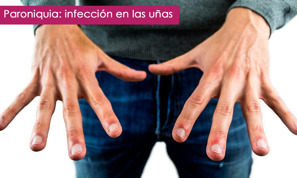 paroniquia o infección en las uñas