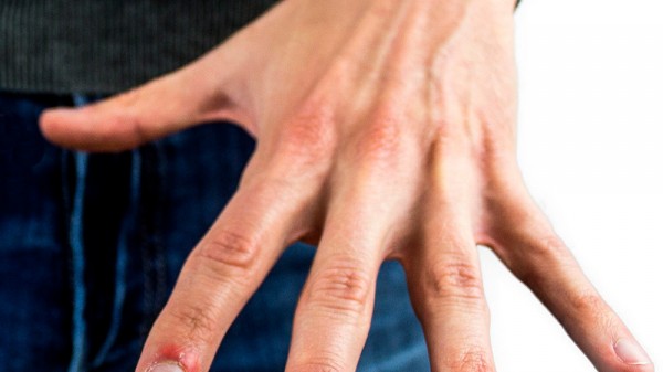 Paroniquia: ¿qué causa la infección en las uñas y cómo solucionarlo?