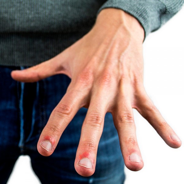 Paroniquia: ¿qué causa la infección en las uñas y cómo solucionarlo?