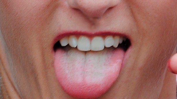 Qué significa tener la lengua blanca y pastosa