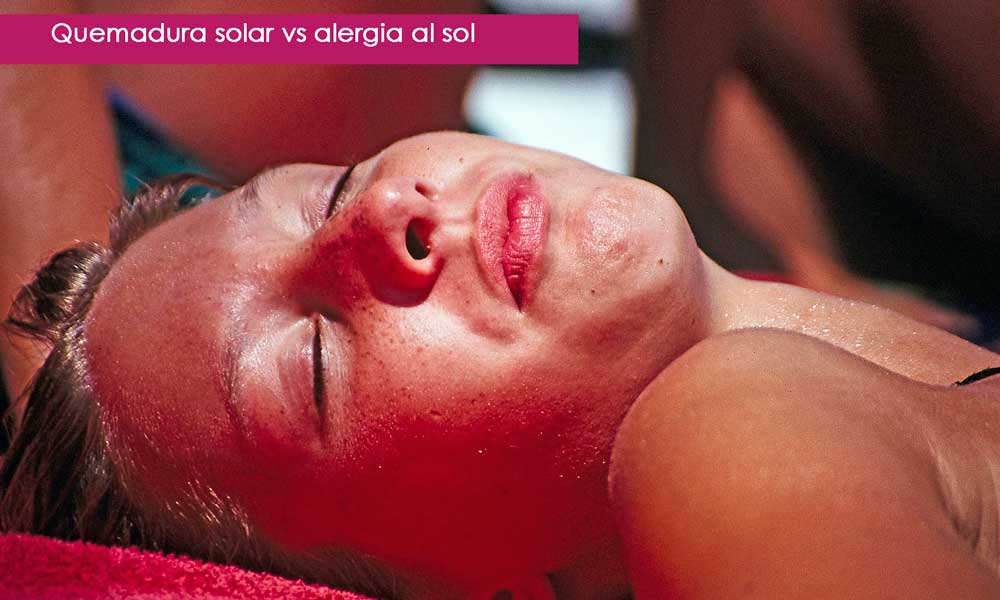 quemadura solar vs alergia al sol, diferencias