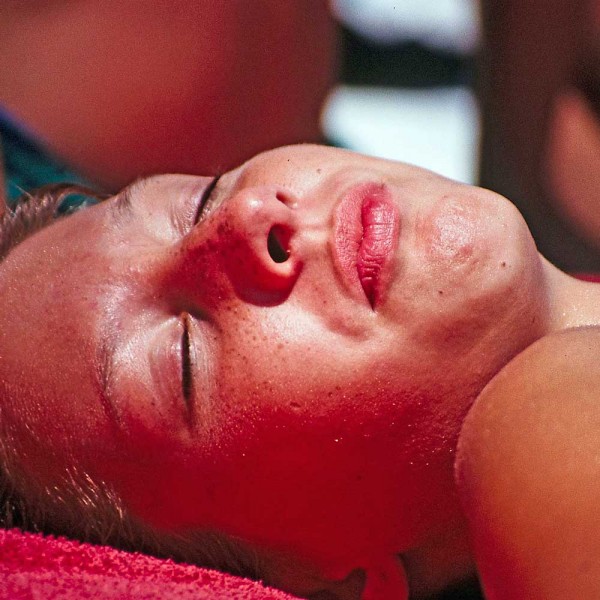 Cómo diferenciar la alergia solar de una quemadura del sol