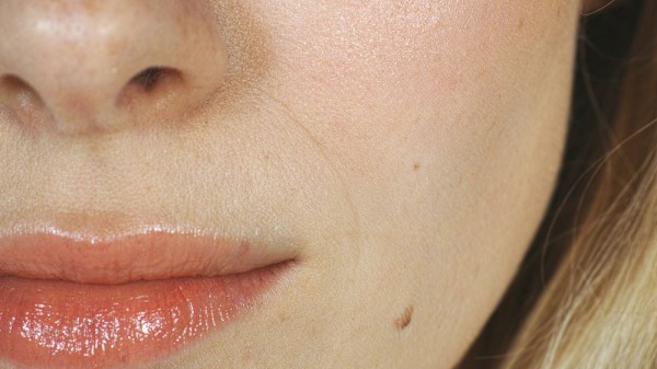 Por qué salen lunares en la piel. Qué son los lunares, qué los causan y cuándo son peligrosos