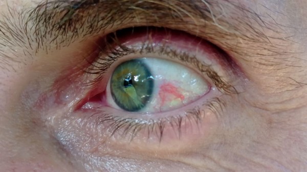 Derrame en el ojo: ¿por qué ocurre y qué hacer?