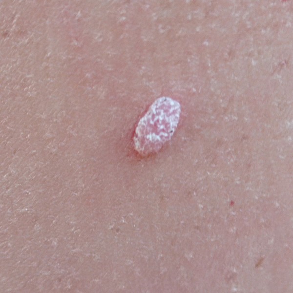 Verrugas víricas: por qué salen y cómo tratarlas