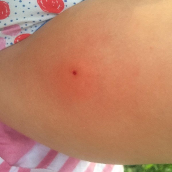 Qué hacer si te pica una avispa o una abeja