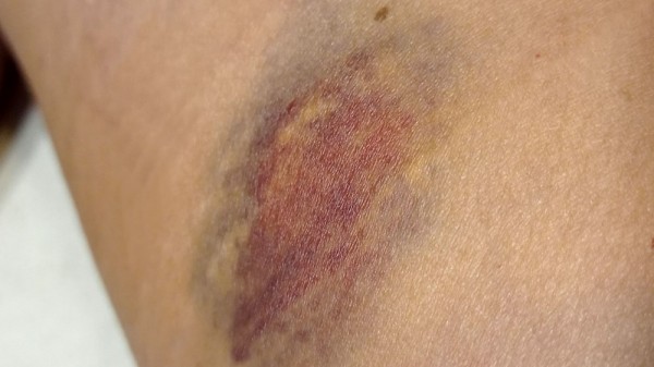 Moretones en la piel: por qué salen y cómo curar estos hematomas