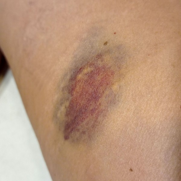 Moretones en la piel: por qué salen y cómo curar estos hematomas