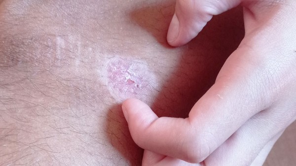 ¿Es malo arrancarse las costras de la piel?