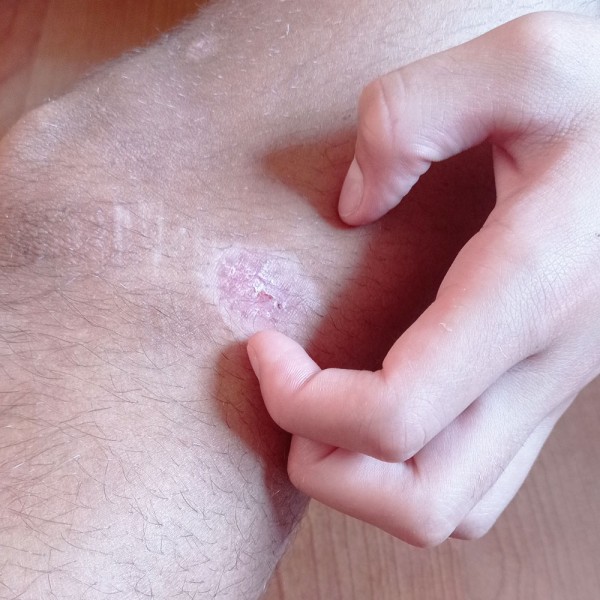 ¿Es malo arrancarse las costras de la piel?