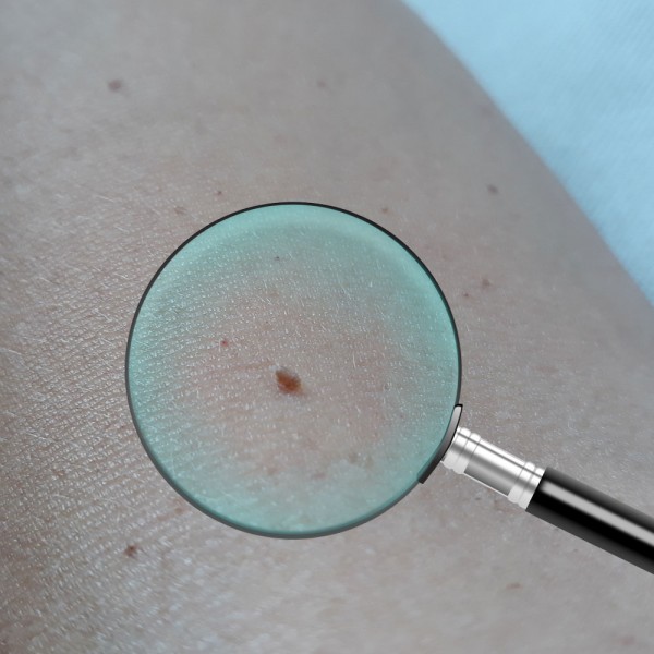 Por qué me salen verrugas. Causas, prevención y tratamiento de las verrugas en la piel