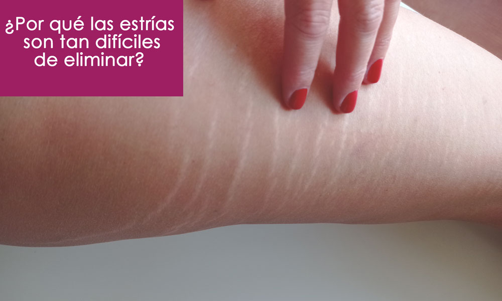 las estrías son muy difíciles de eliminar