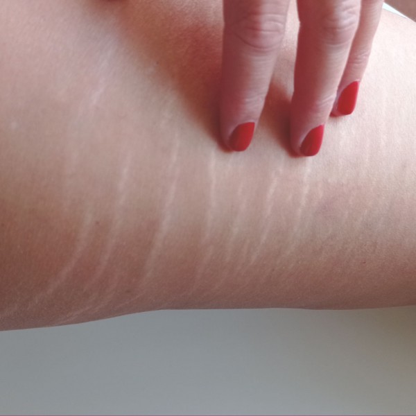 Estrías en la piel: ¿por qué es tan difícil eliminarlas?