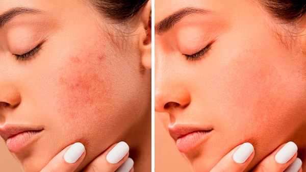 Cómo eliminar granos e imperfecciones con Phosothop (¡muy fácil!)